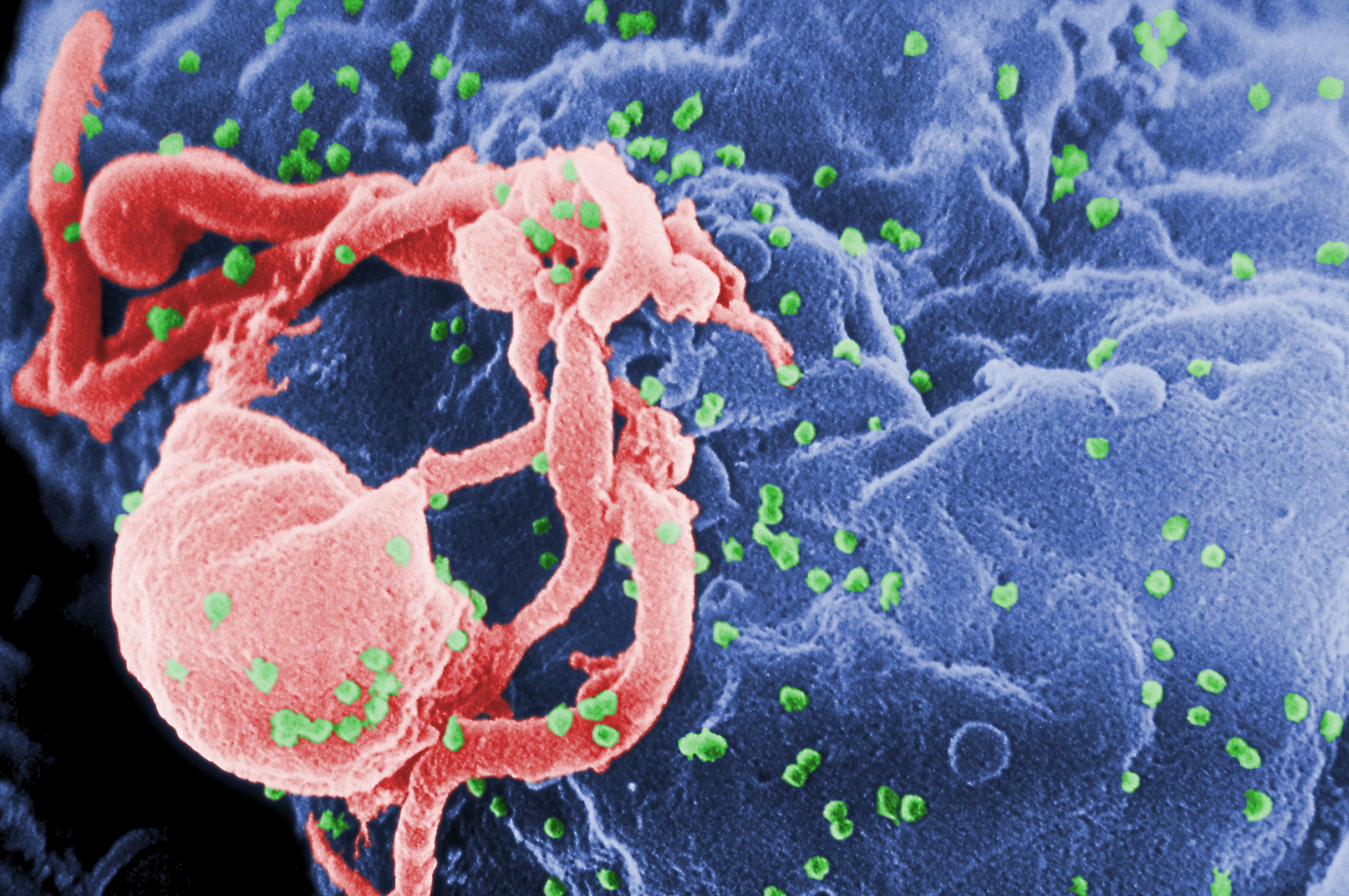HIV là virus gây ra hội chứng suy giảm miễn dịch mắc phải ở người